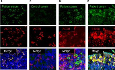 Clinical Heterogeneity of Acquired Idiopathic Isolated Adrenocorticotropic Hormone Deficiency